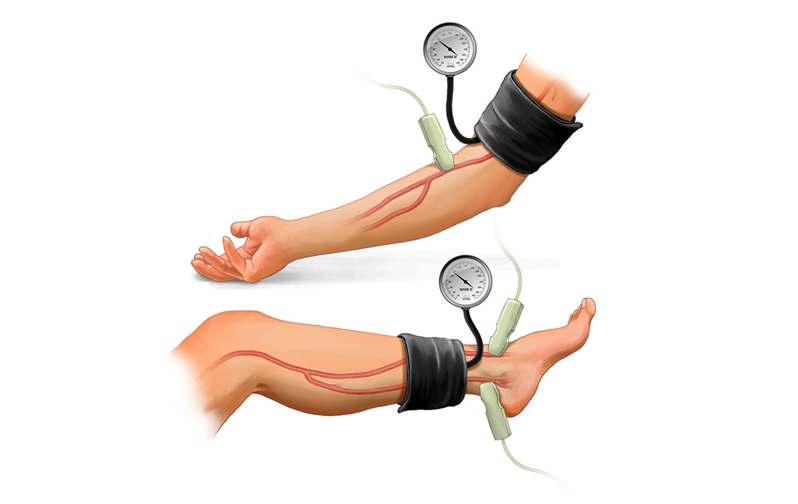Ankle Brachial Index